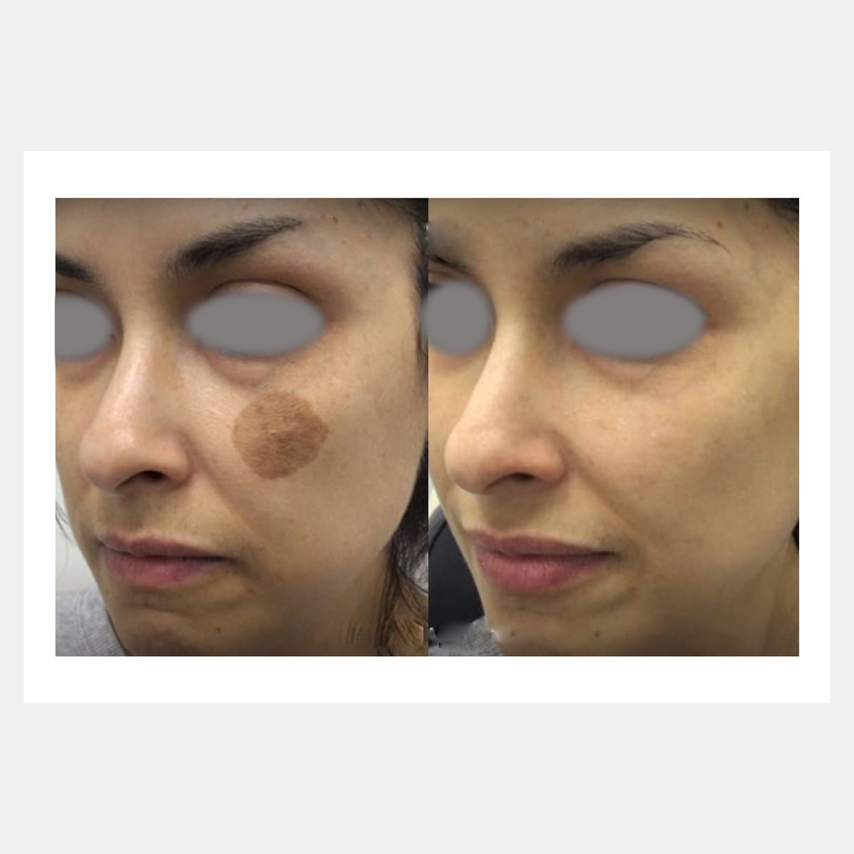 BiAxis QS before and after — birthmark removal