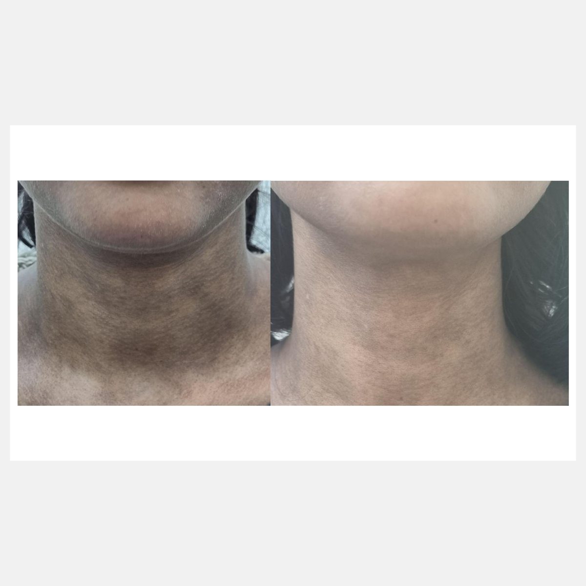 BiAxis QS before and after — lichen planus pigmentosus
