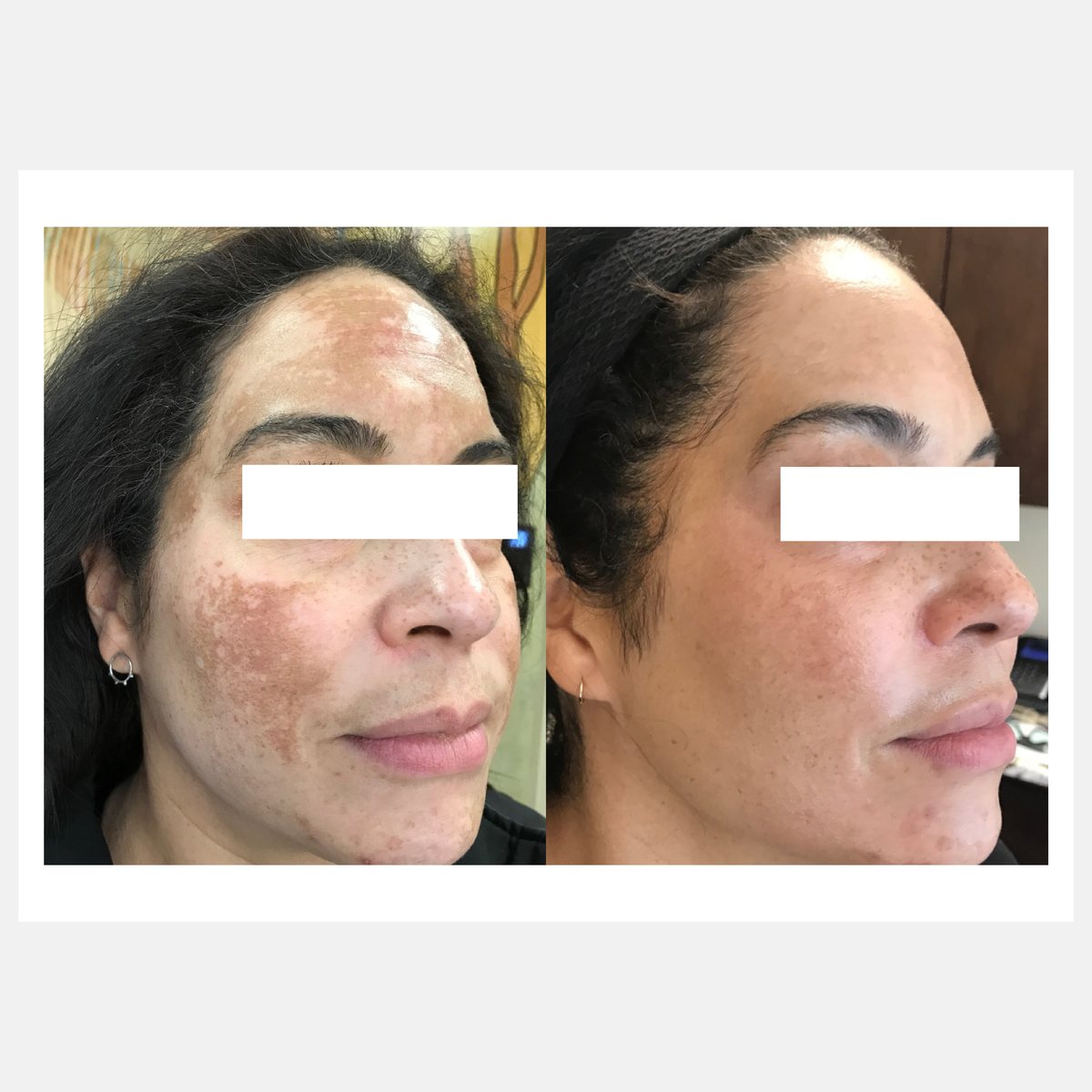 BiAxis QS before and after — melasma