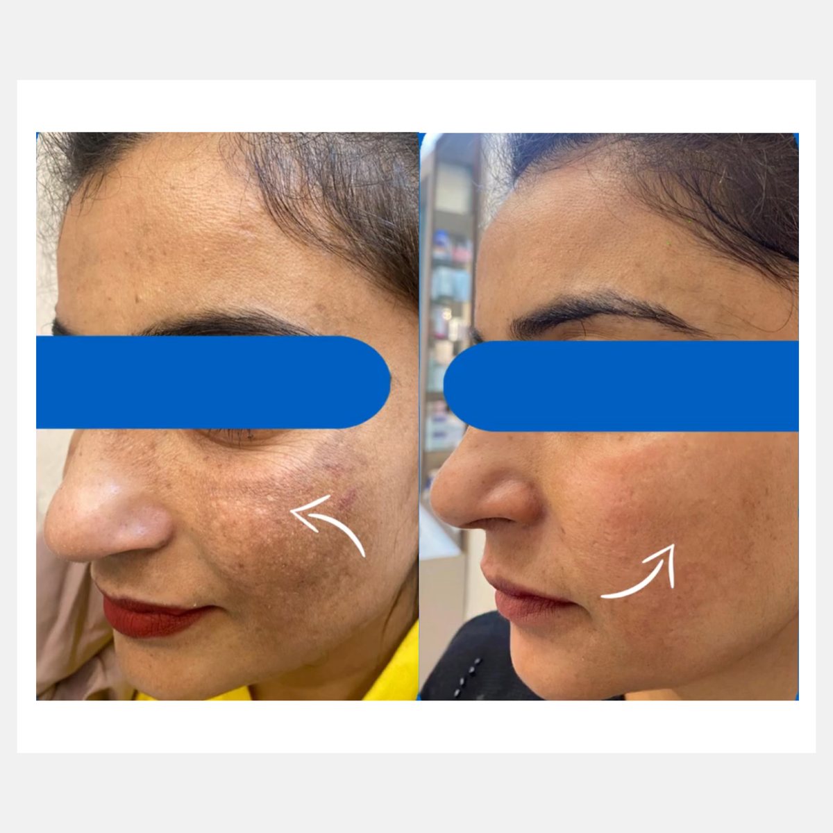 BiAxis QS before and after — melasma