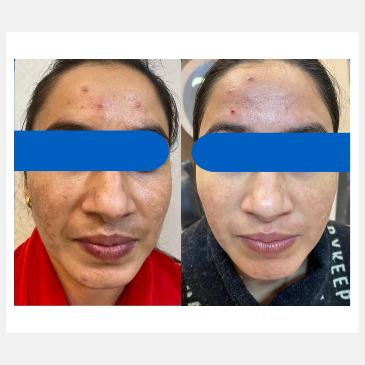 BiAxis QS before and after — melasma