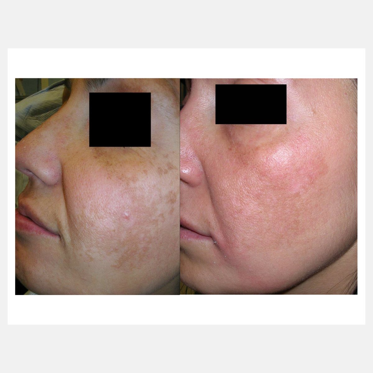 BiAxis QS before and after — melasma