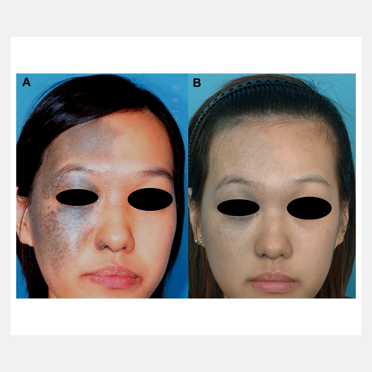BiAxis QS before and after — nevus of Ota