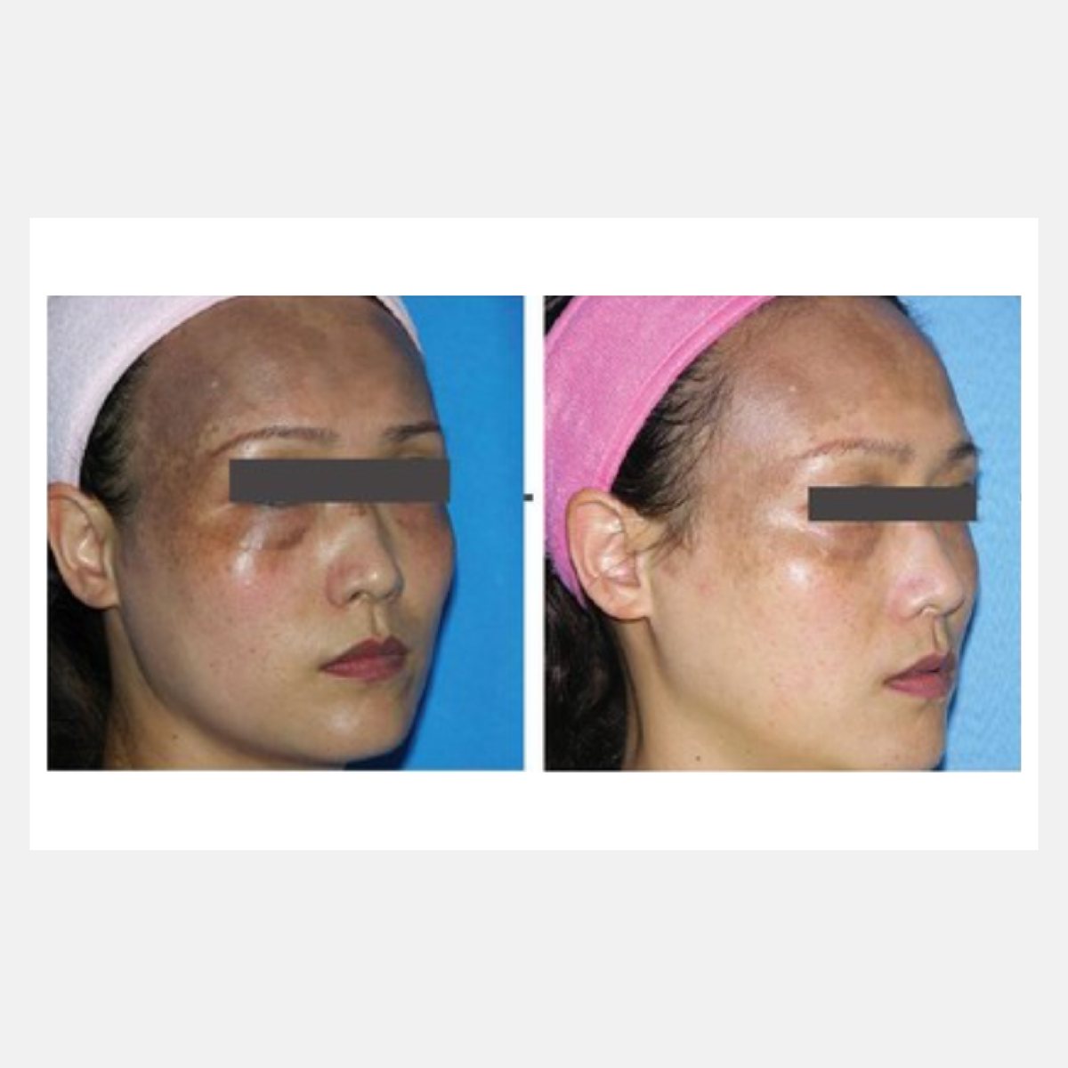 BiAxis QS before and after — nevus of Ota