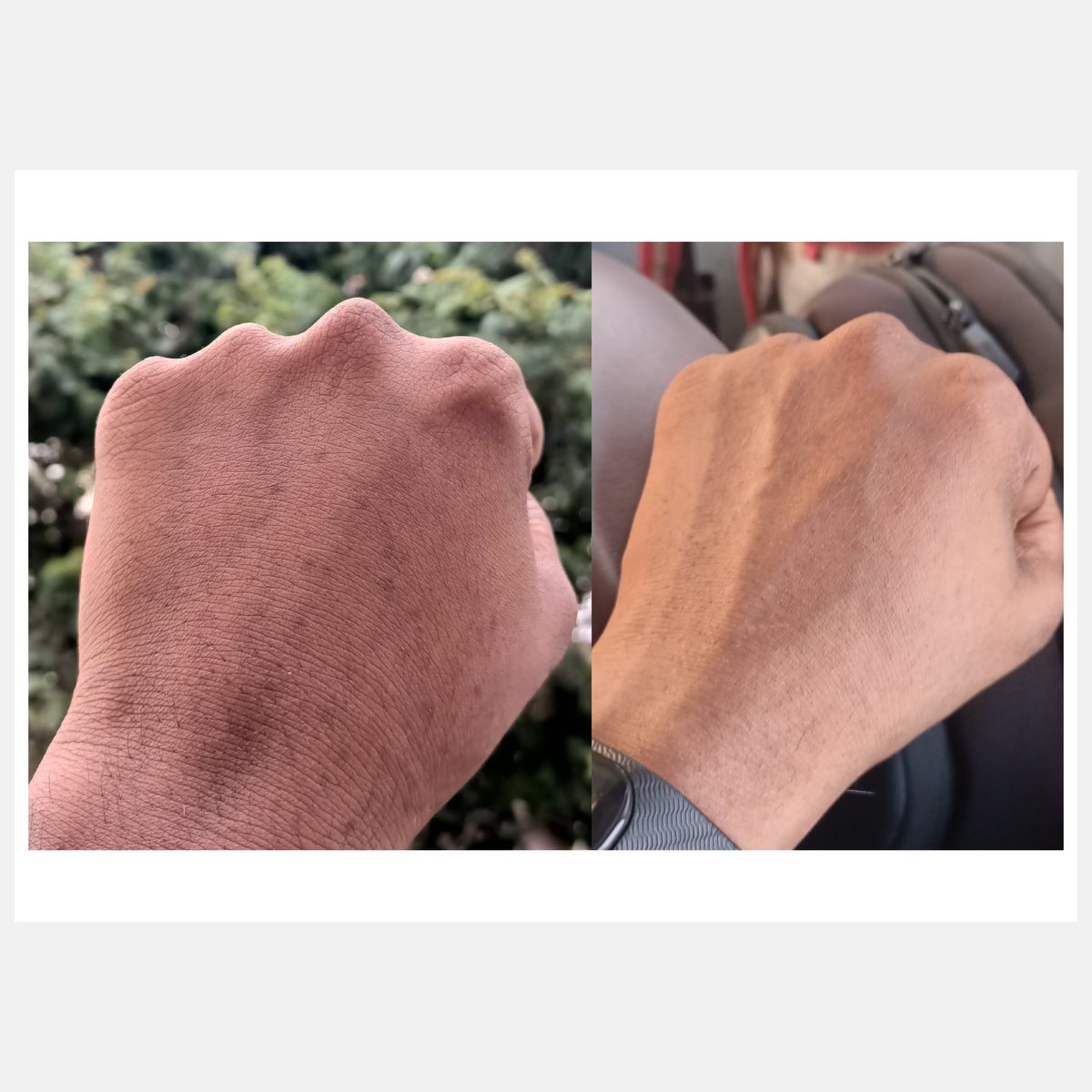 BiAxis QS before and after — pigmentation