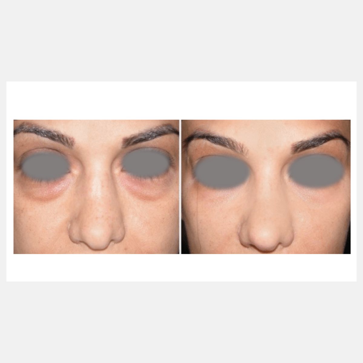 BiAxis before and after — Rejuvenation