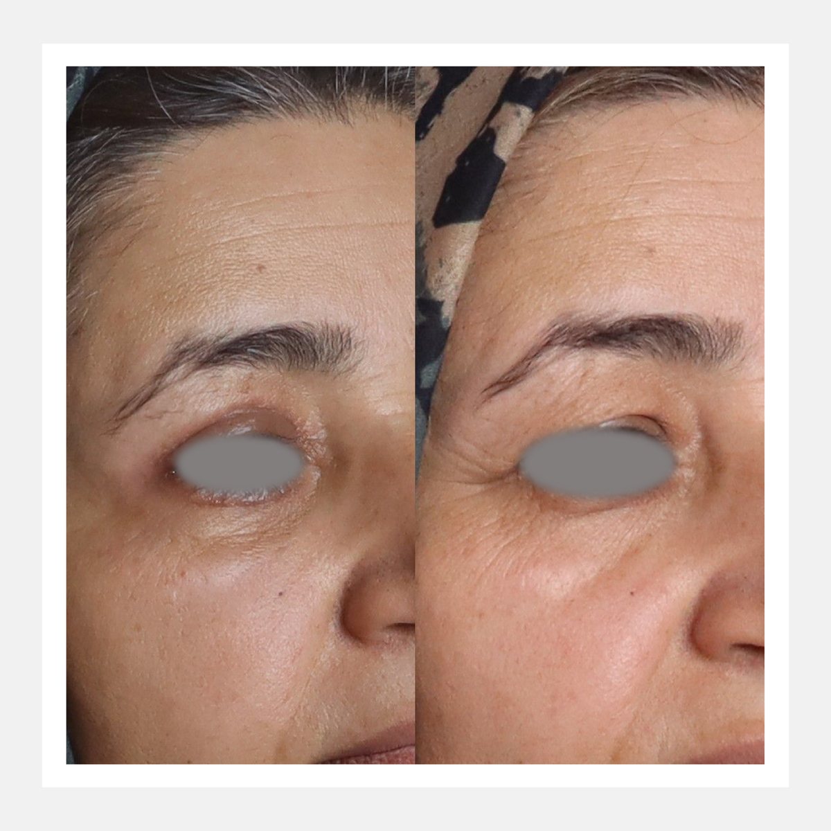 BiAxis before and after — Rejuvenation