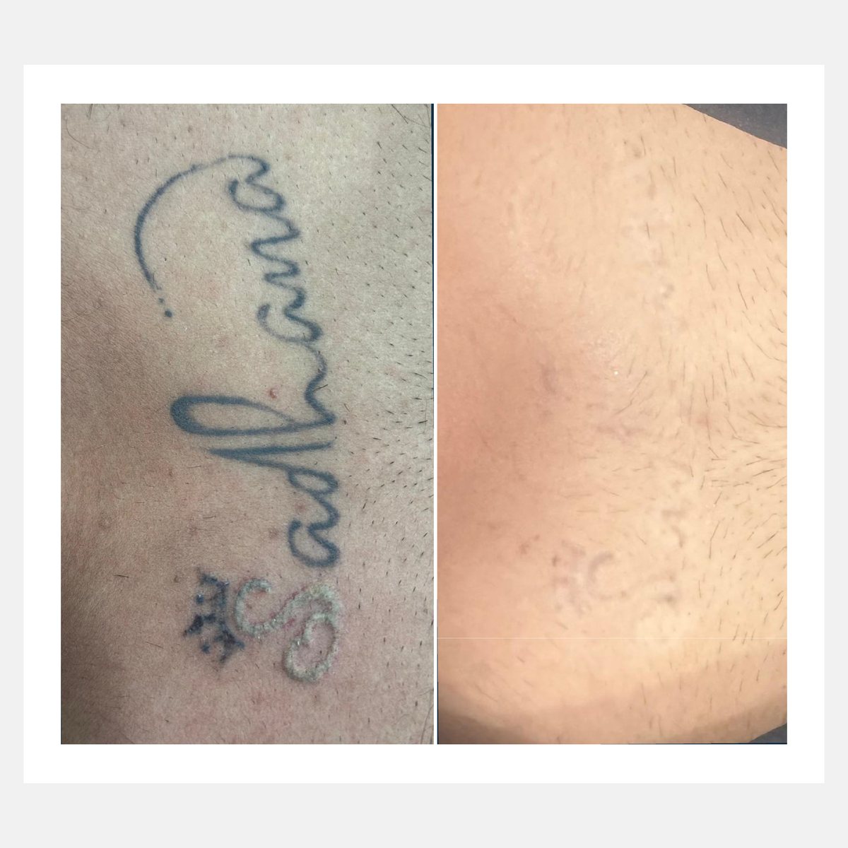 BiAxis QS before and after — tattoo removal