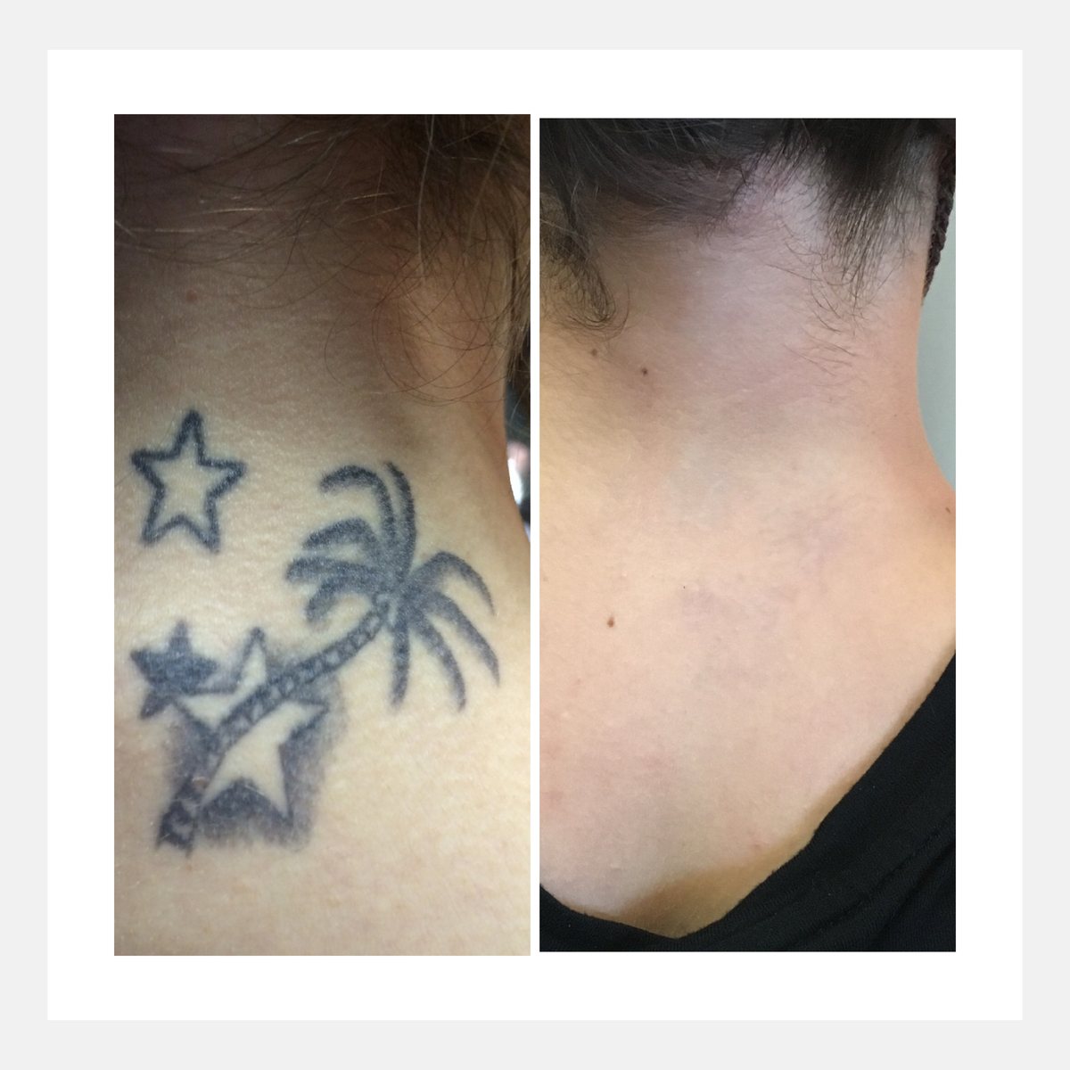 BiAxis QS before and after — tattoo removal