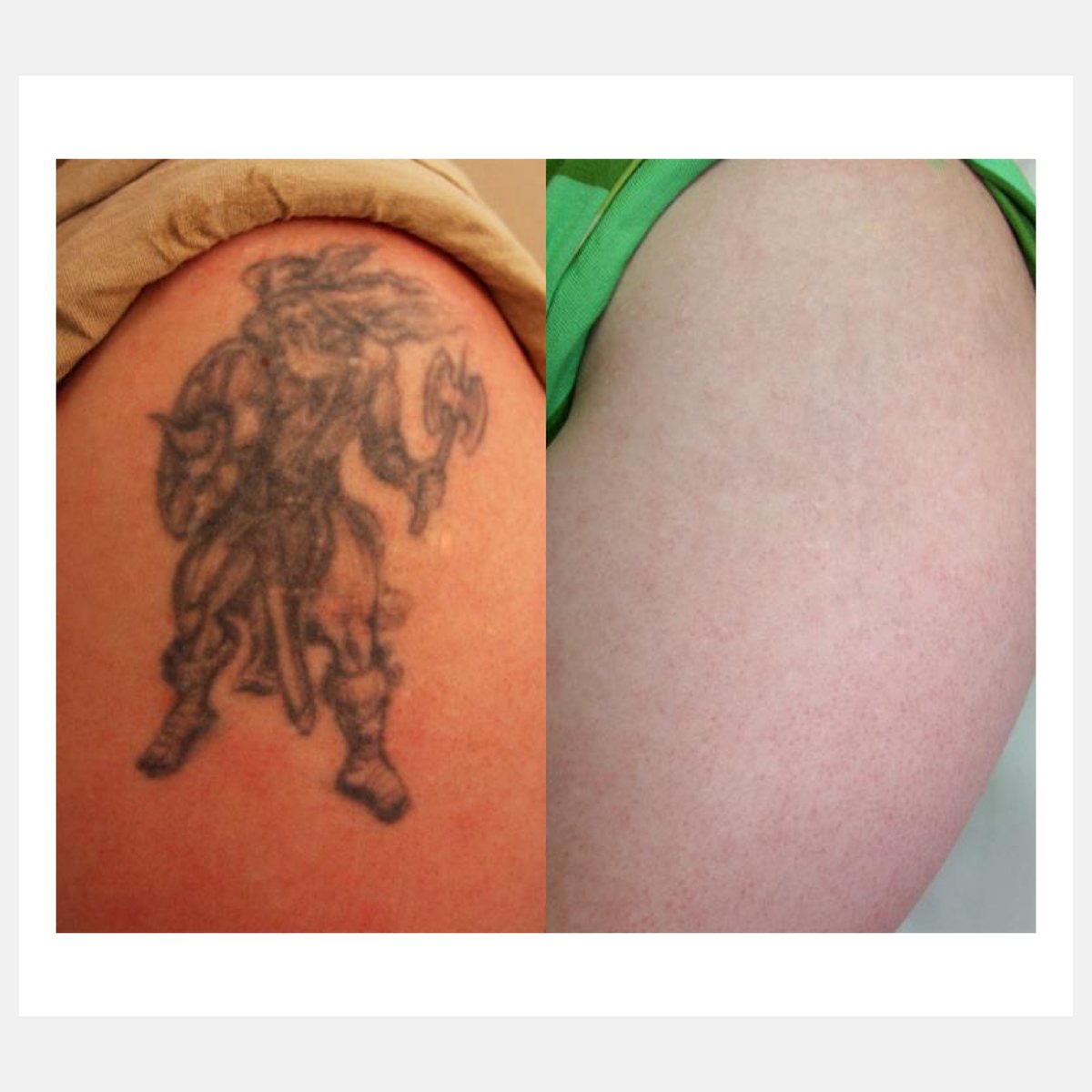 BiAxis QS before and after — tattoo removal