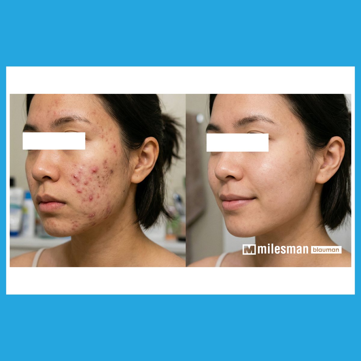 Vossman Blauman before and after — Active Acne