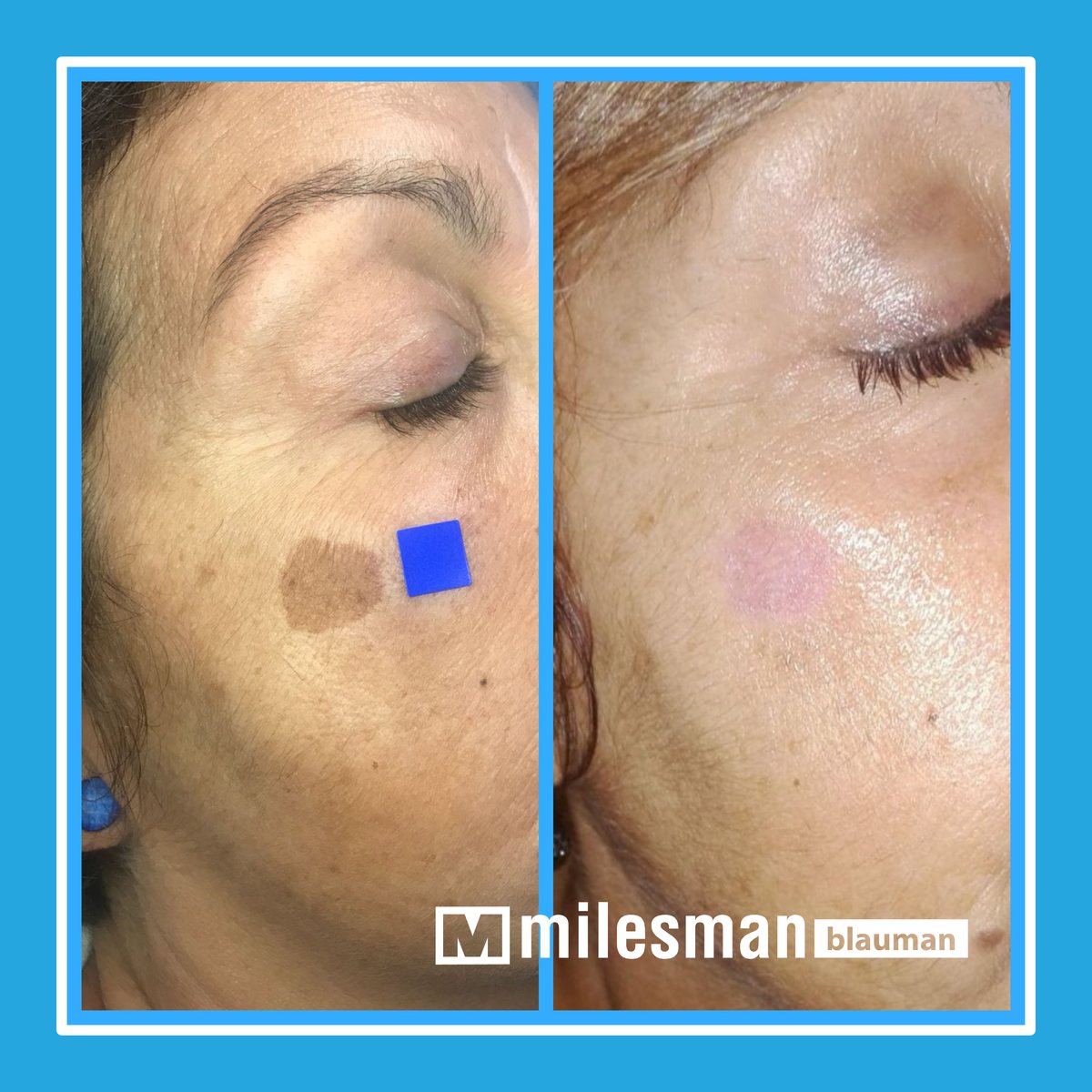Vossman Blauman before and after — Birthmark