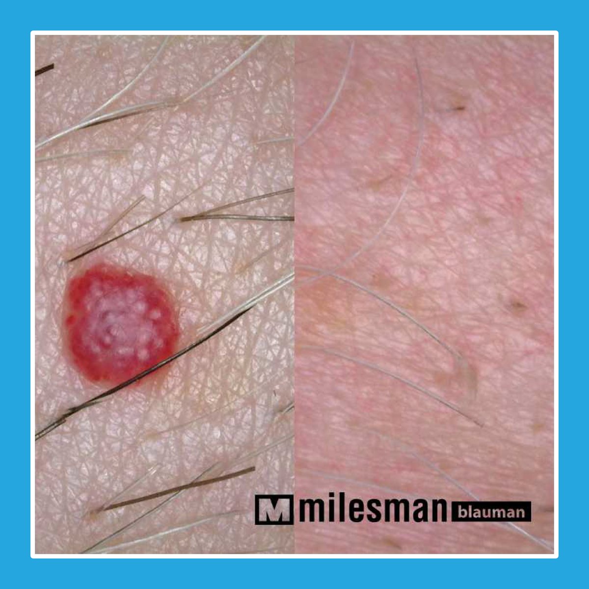 Vossman Blauman before and after — Cherry Angioma
