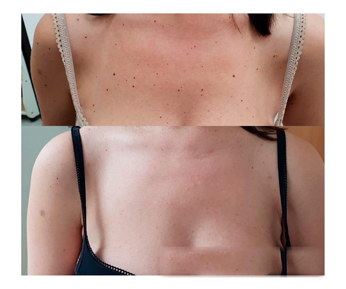 Vossman Blauman before and after — Cherry Angioma