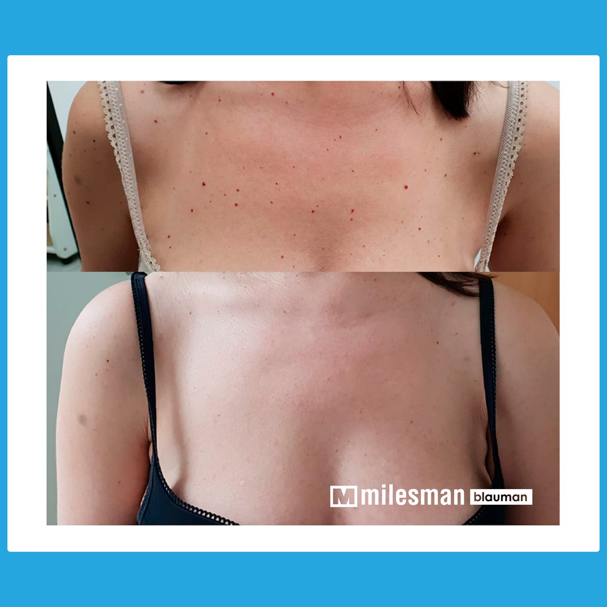 Vossman Blauman before and after — Cherry Angioma