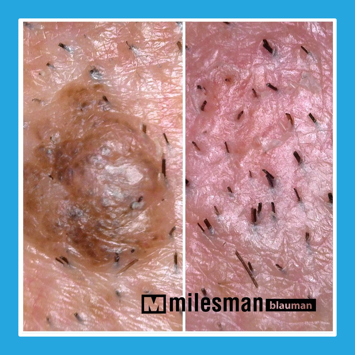 Vossman Blauman before and after — Keloid