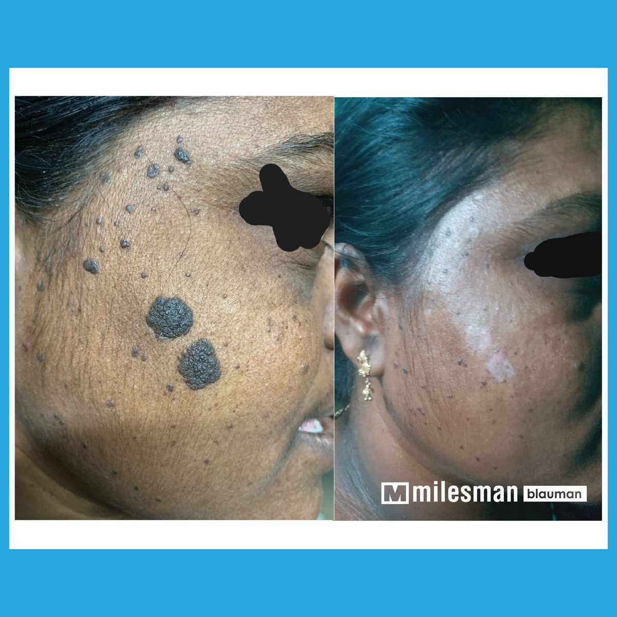 Vossman Blauman before and after — Keratosis