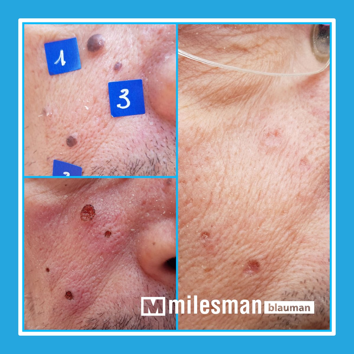 Vossman Blauman before and after — Mole Removal