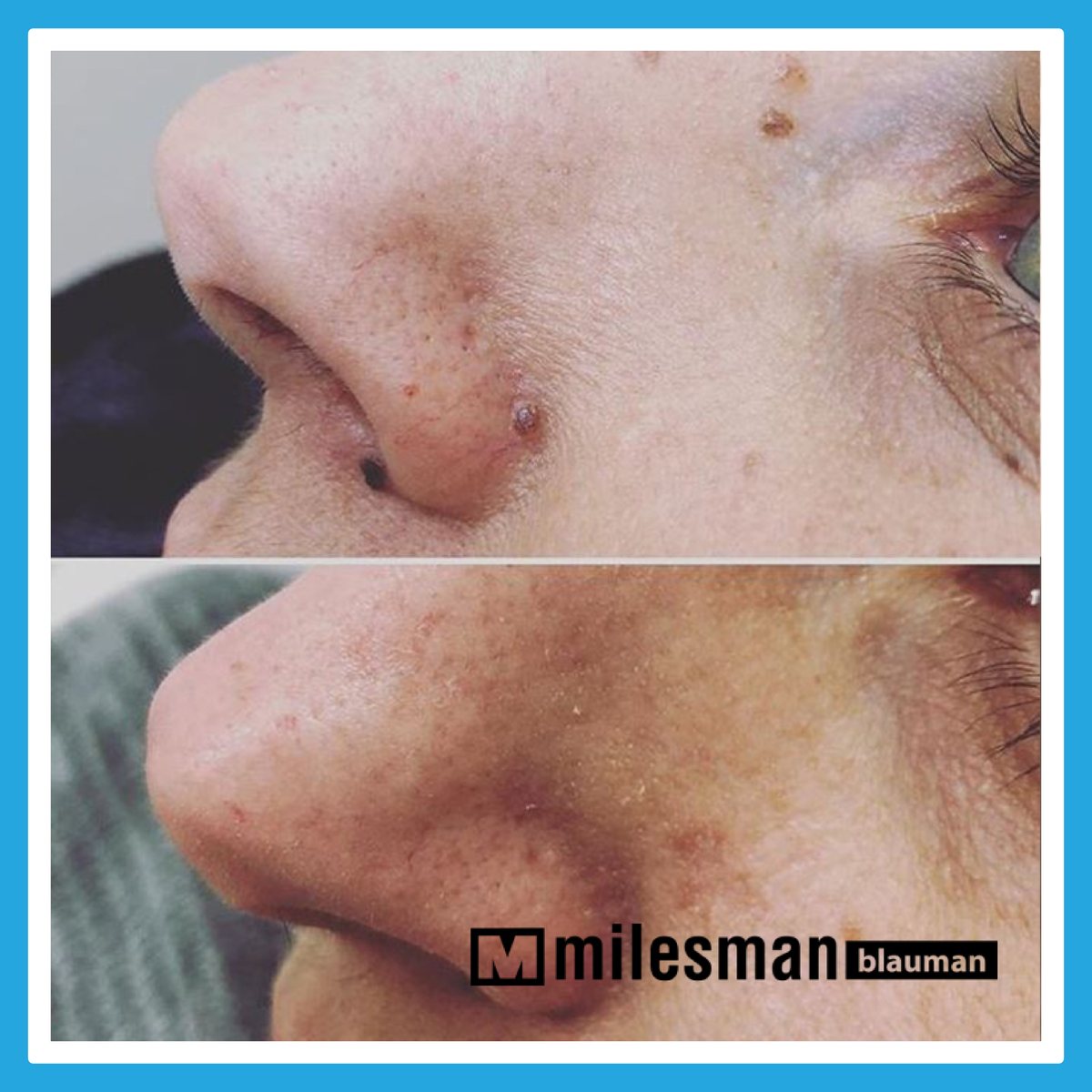 Vossman Blauman before and after — Mole Removal