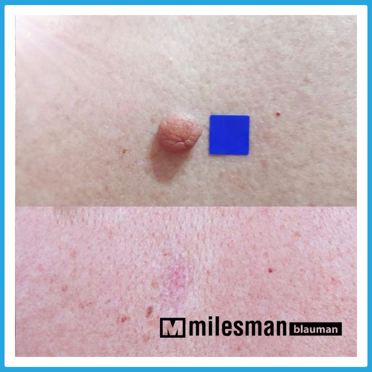 Vossman Blauman before and after — Skin Tag Removal