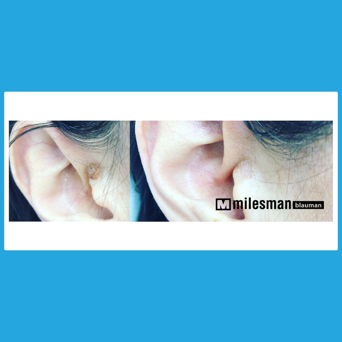 Vossman Blauman before and after — Wart Removal