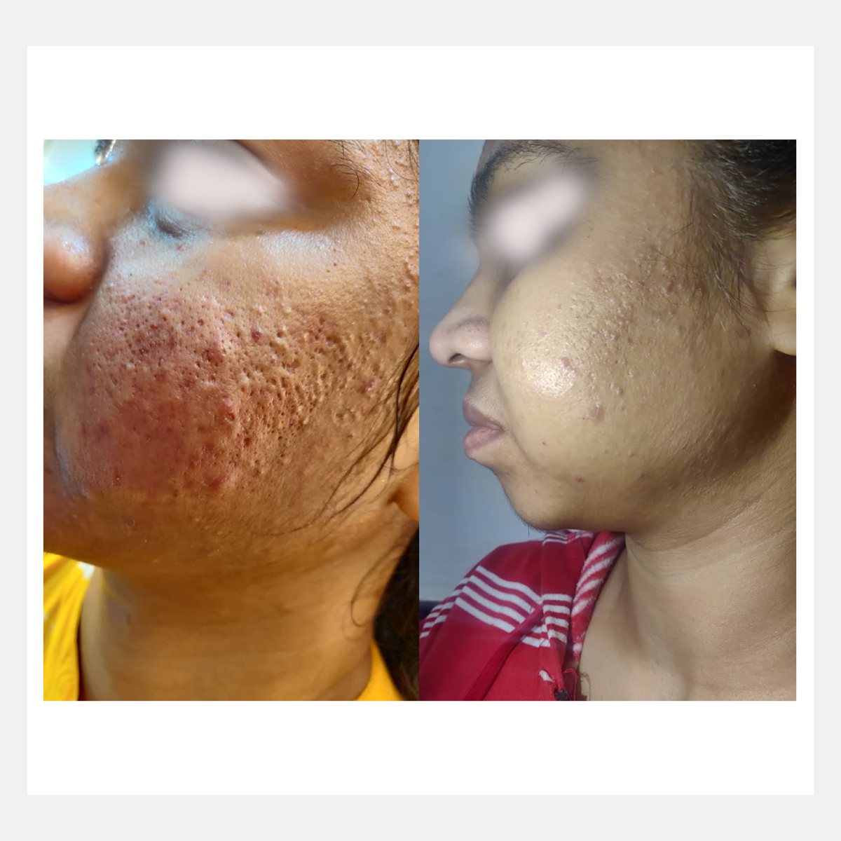 Cellina PR before and after result