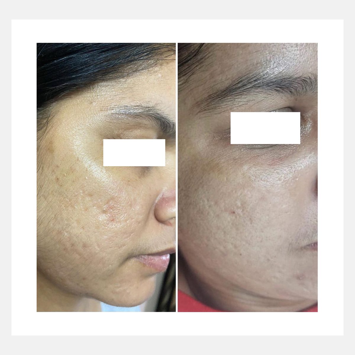 Cellina PR before and after result