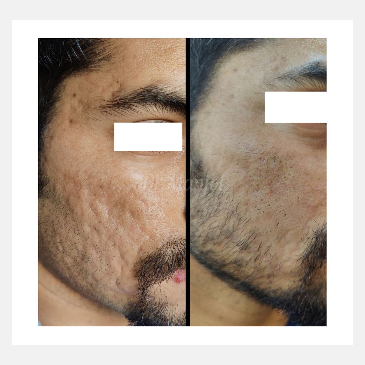 Cellina PR before and after result
