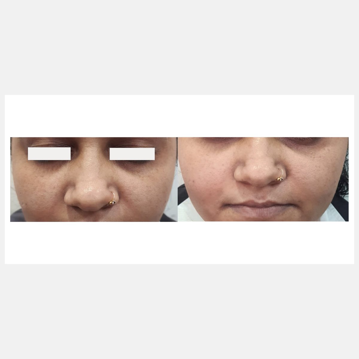 Cellina PR before and after result