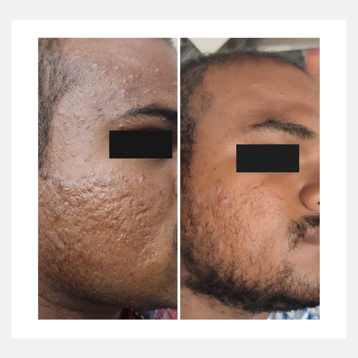 Cellina PR before and after result