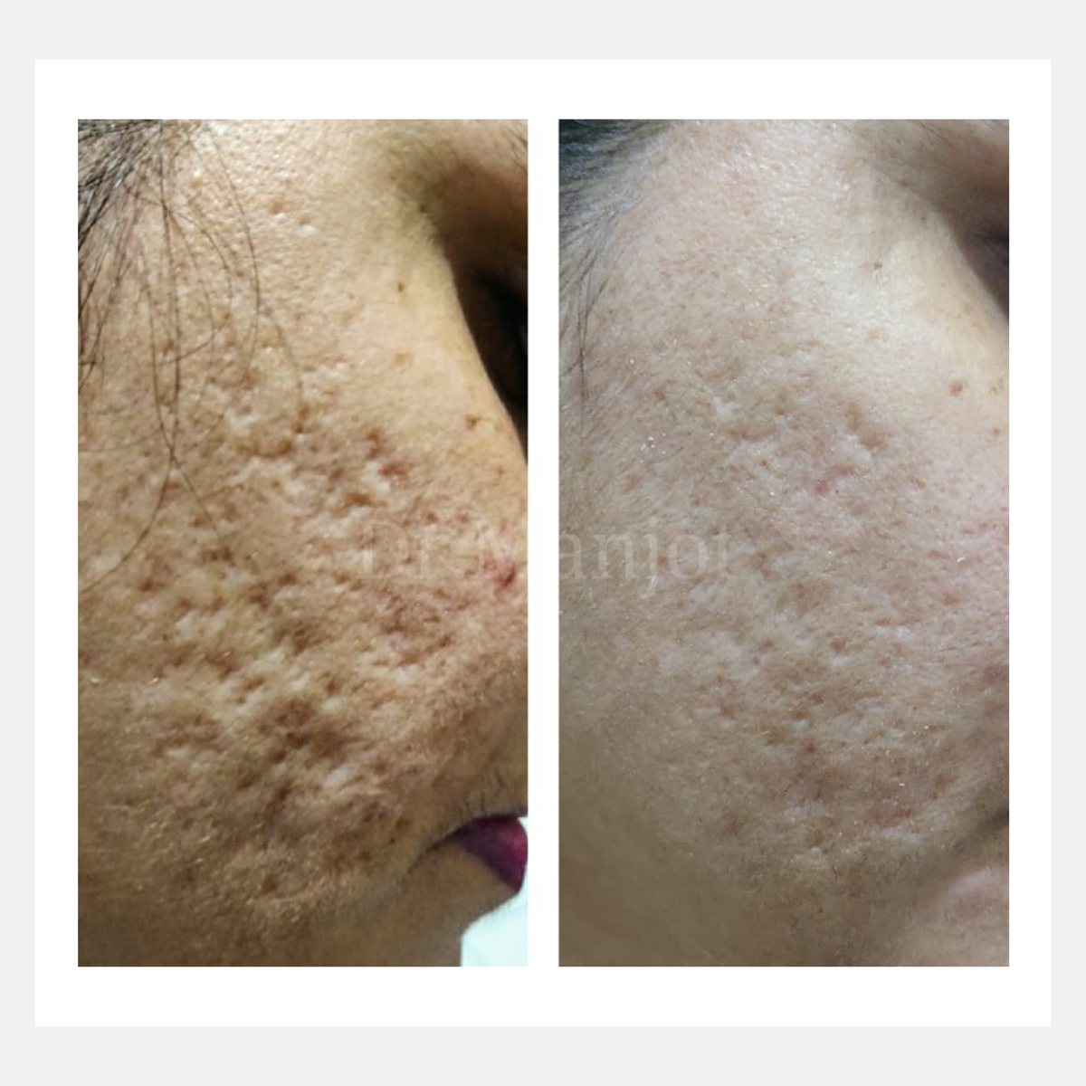 Cellina PR before and after result
