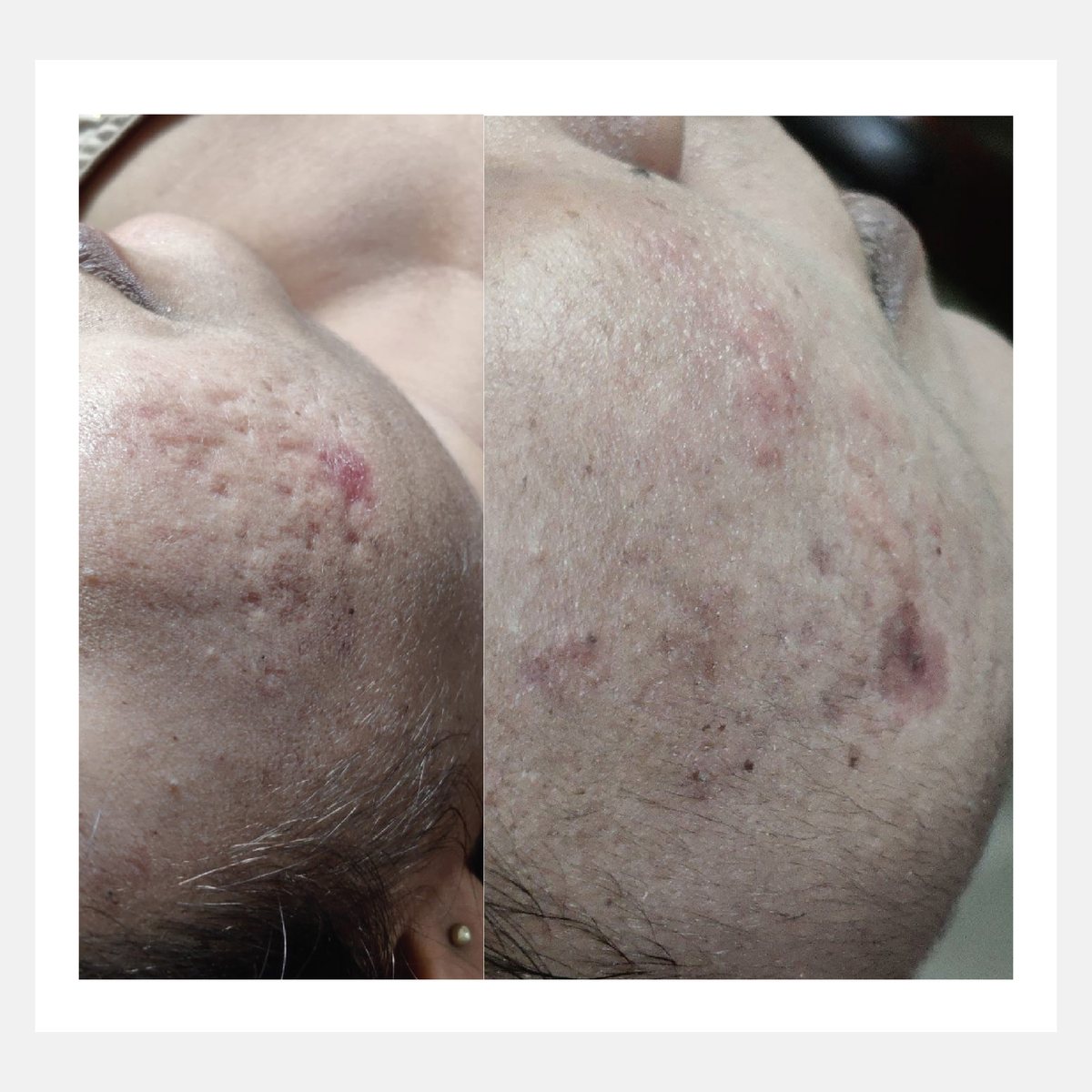 Cellina PR before and after result