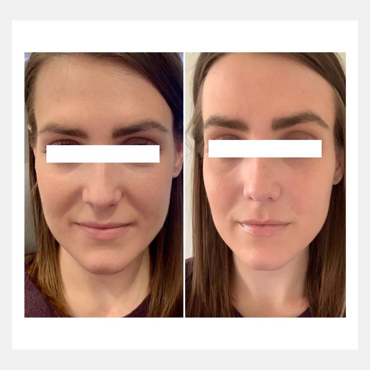 Cellina PR before and after result