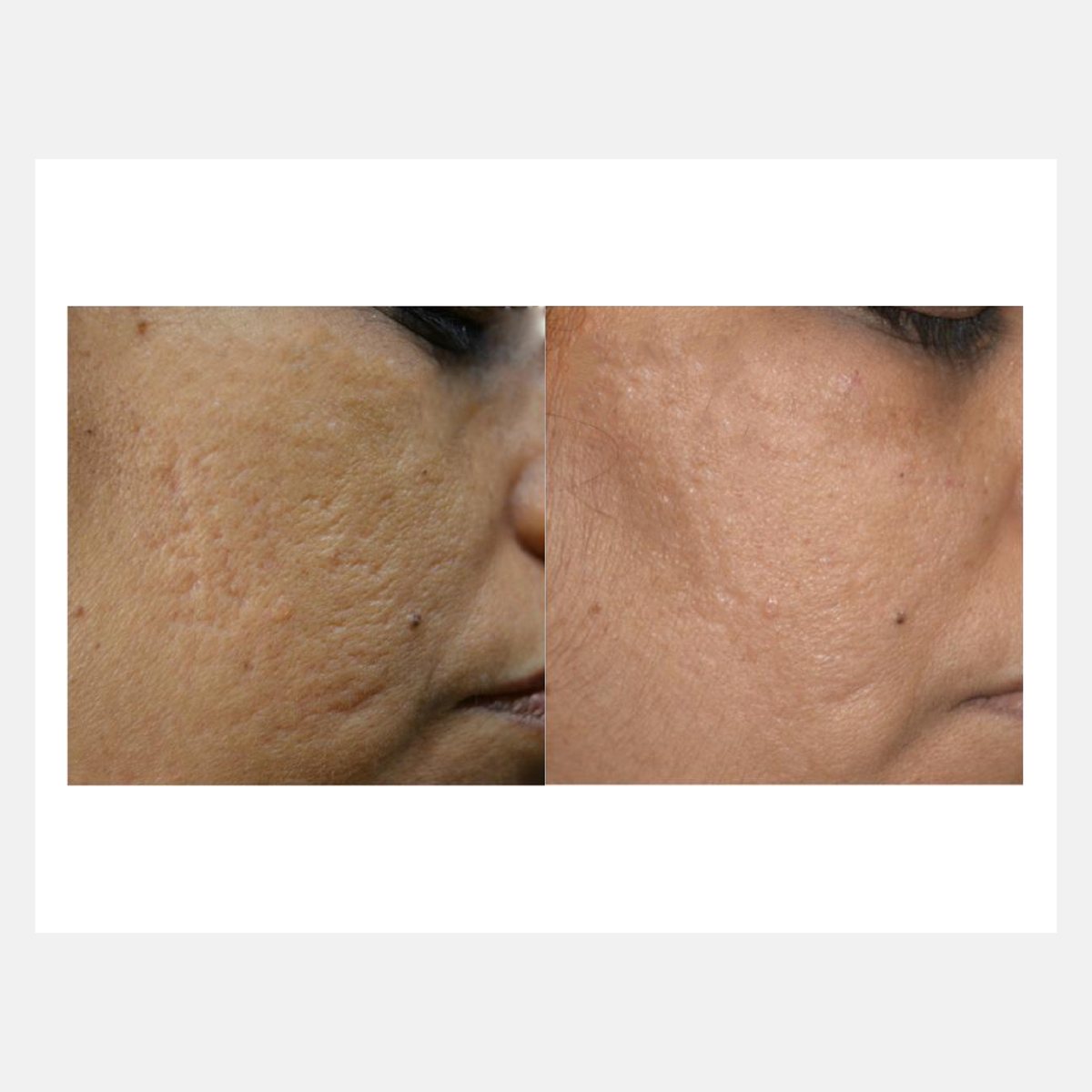 Cellina PR before and after result