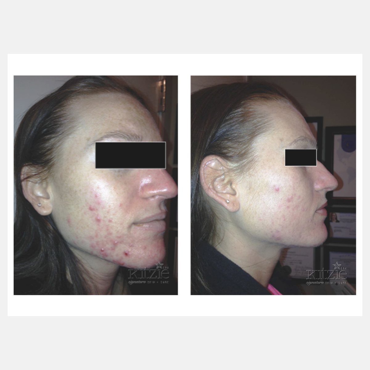 Celluma before and after result
