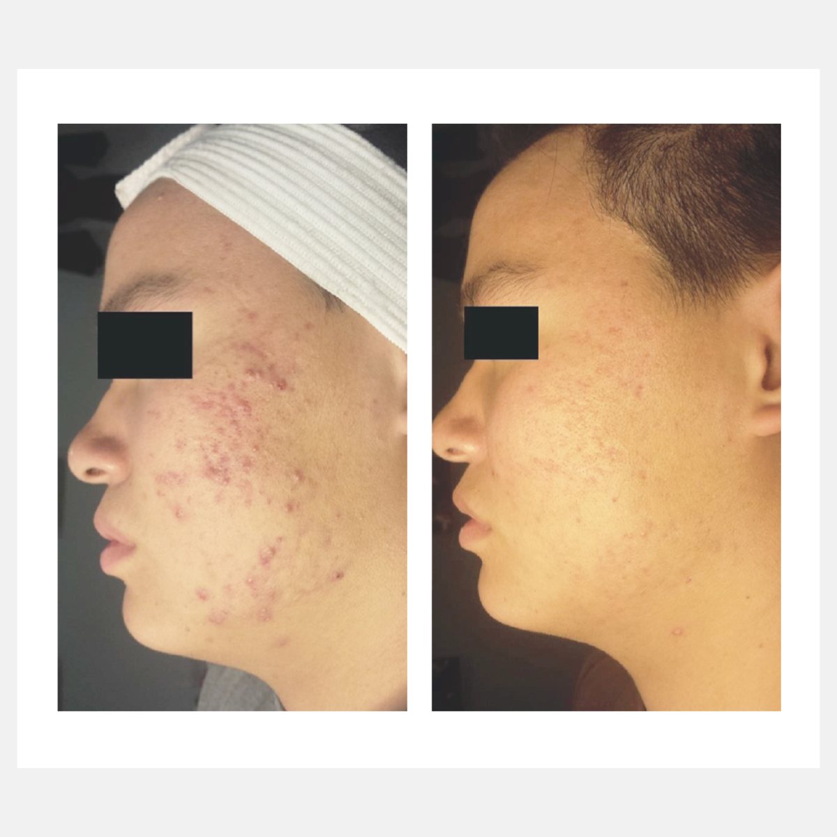 Celluma before and after result