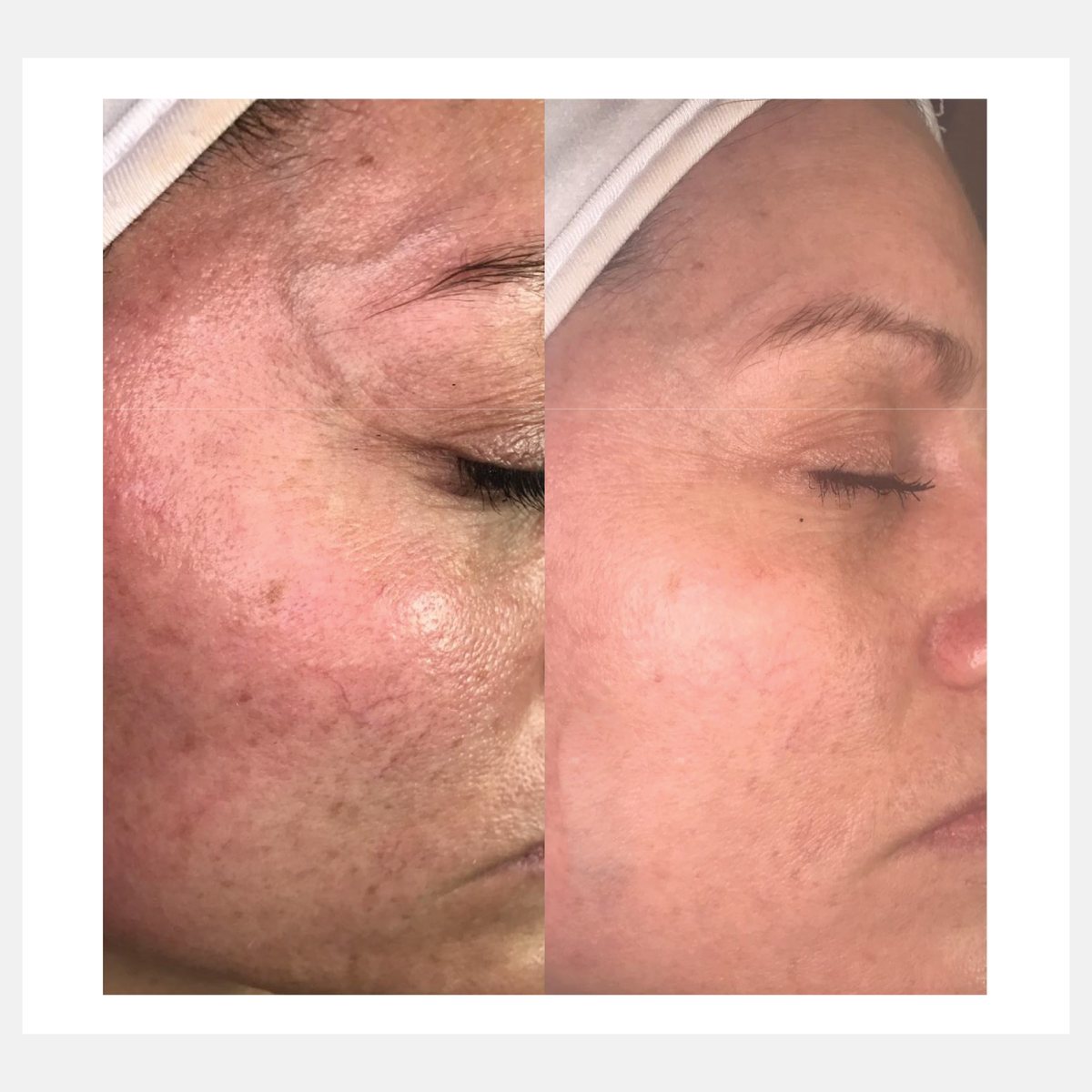 Celluma before and after result