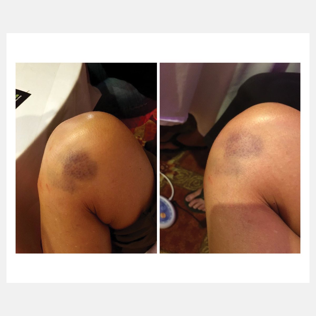 Celluma before and after result