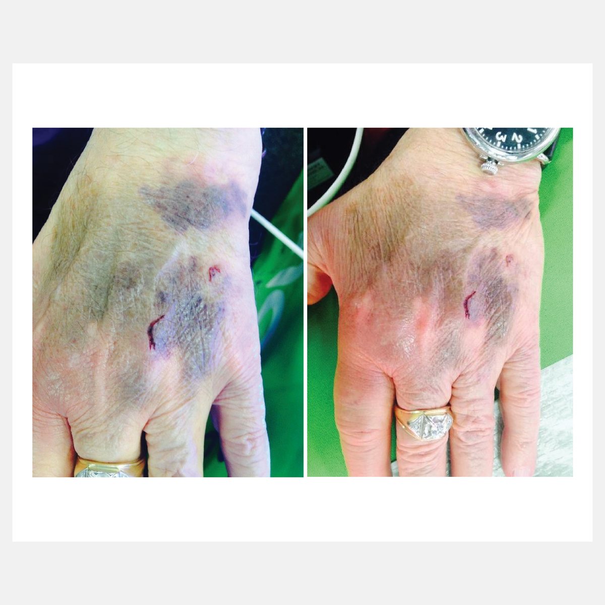 Celluma before and after result