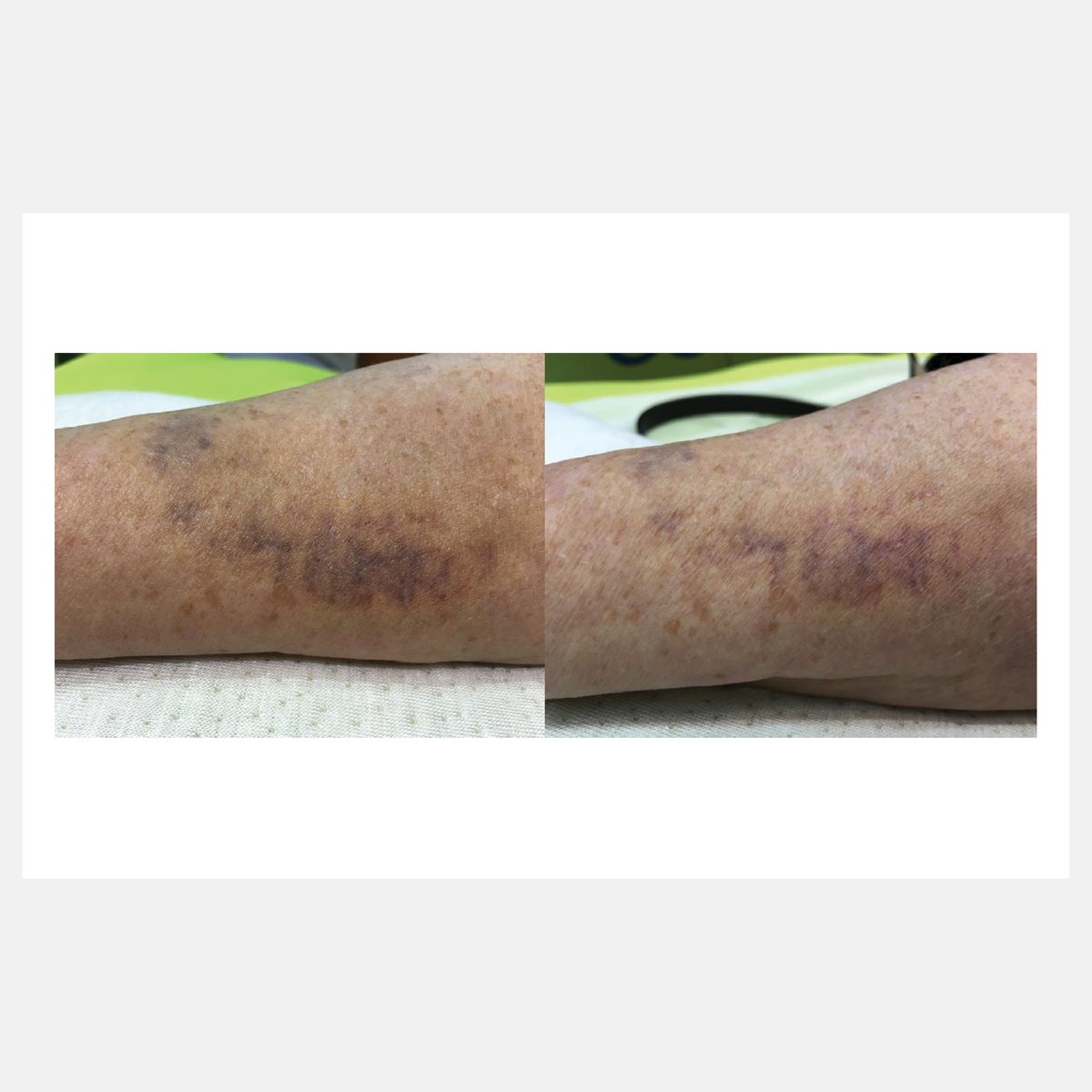 Celluma before and after result