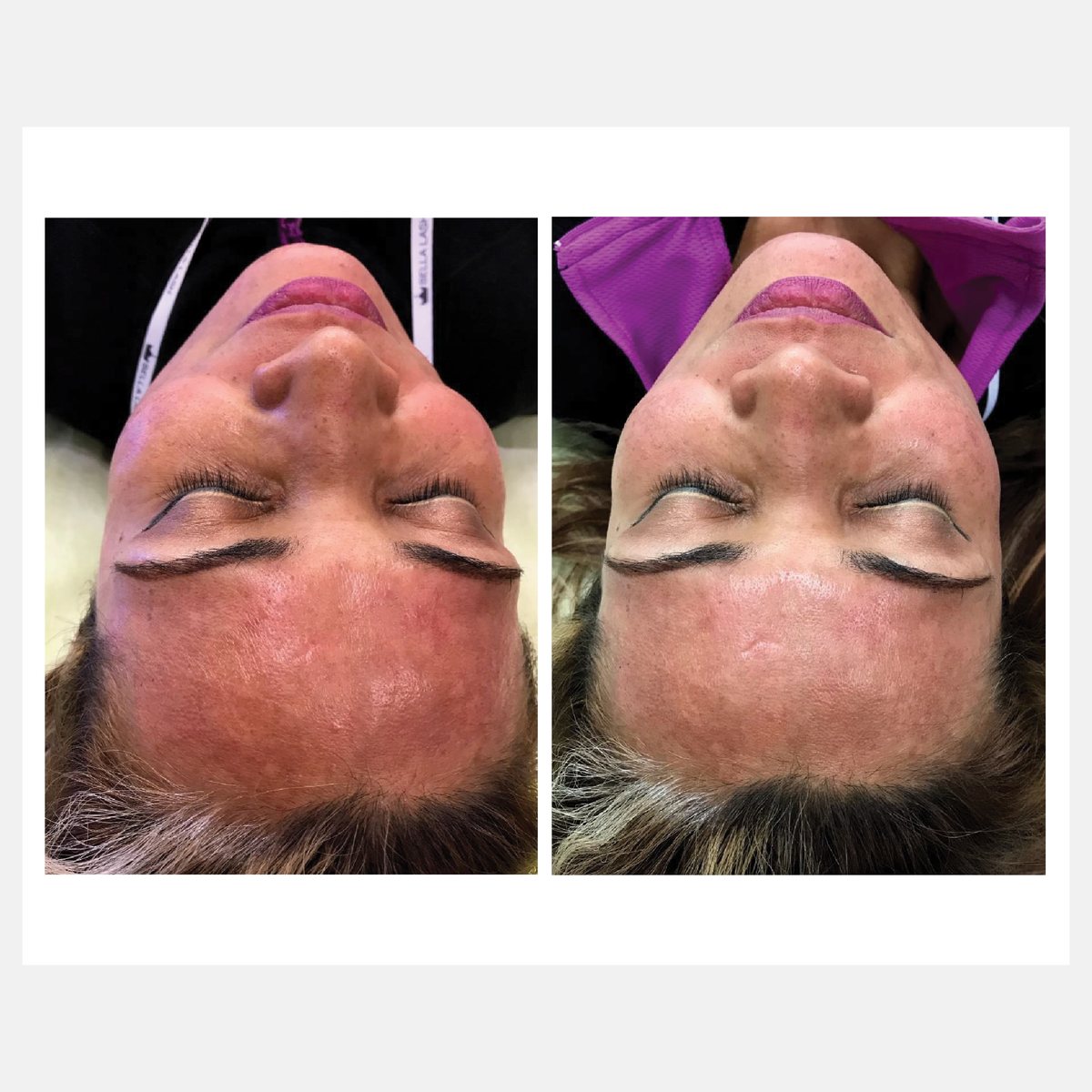 Celluma before and after result