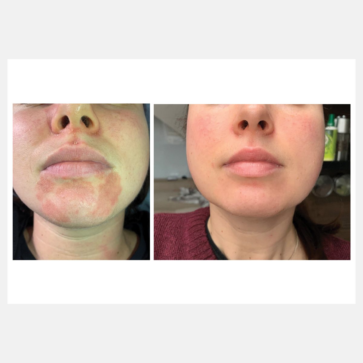 Celluma before and after result