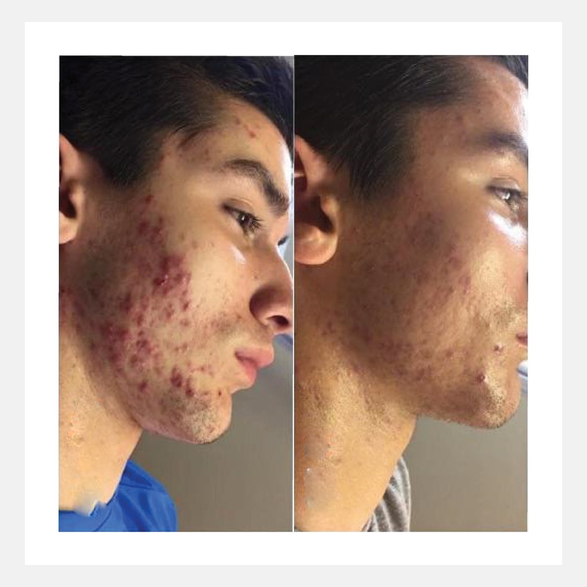 Celluma before and after result