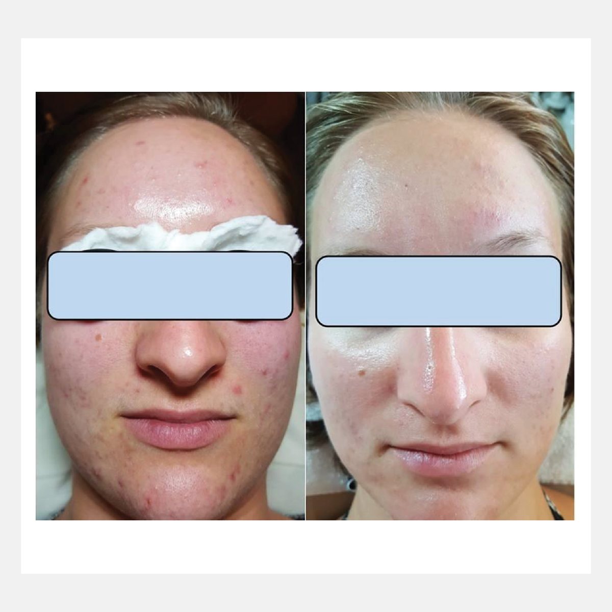 Celluma before and after result