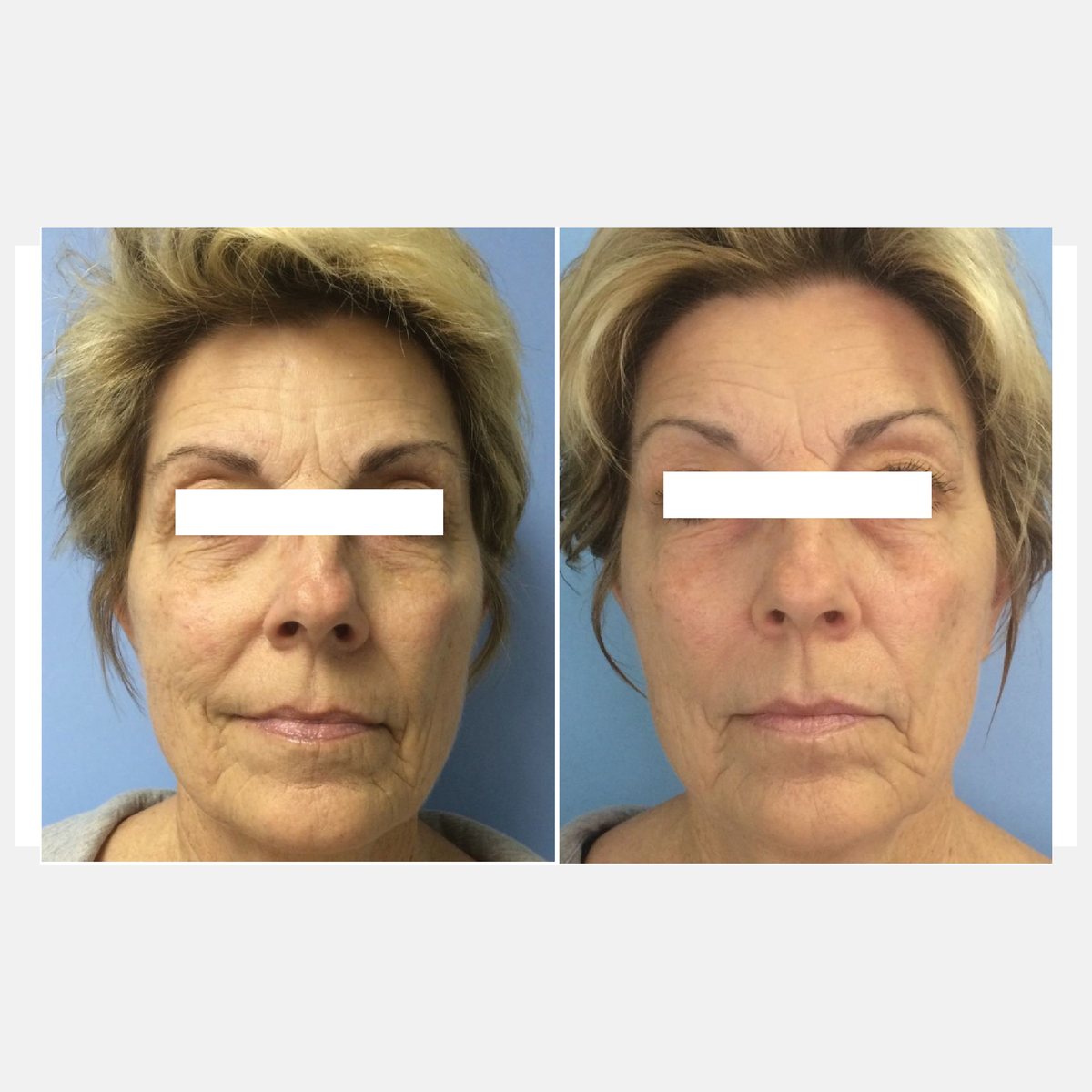 Celluma before and after result