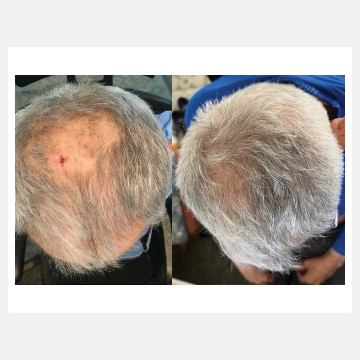 Celluma before and after result