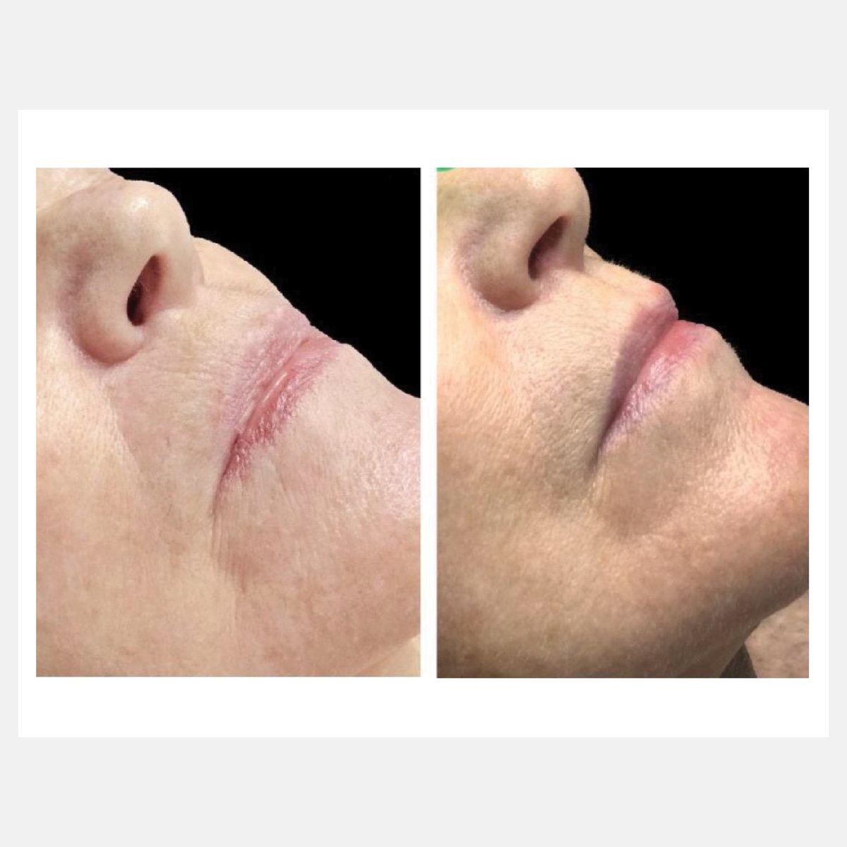 Celluma before and after result