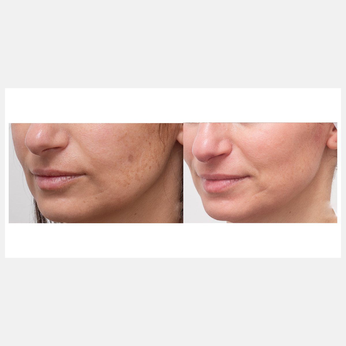 Exofacial before and after result