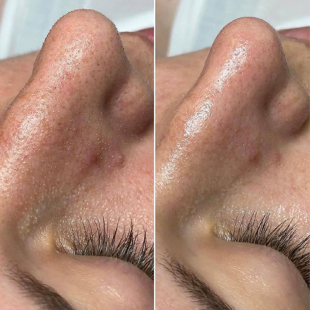 Exofacial pore refinement result