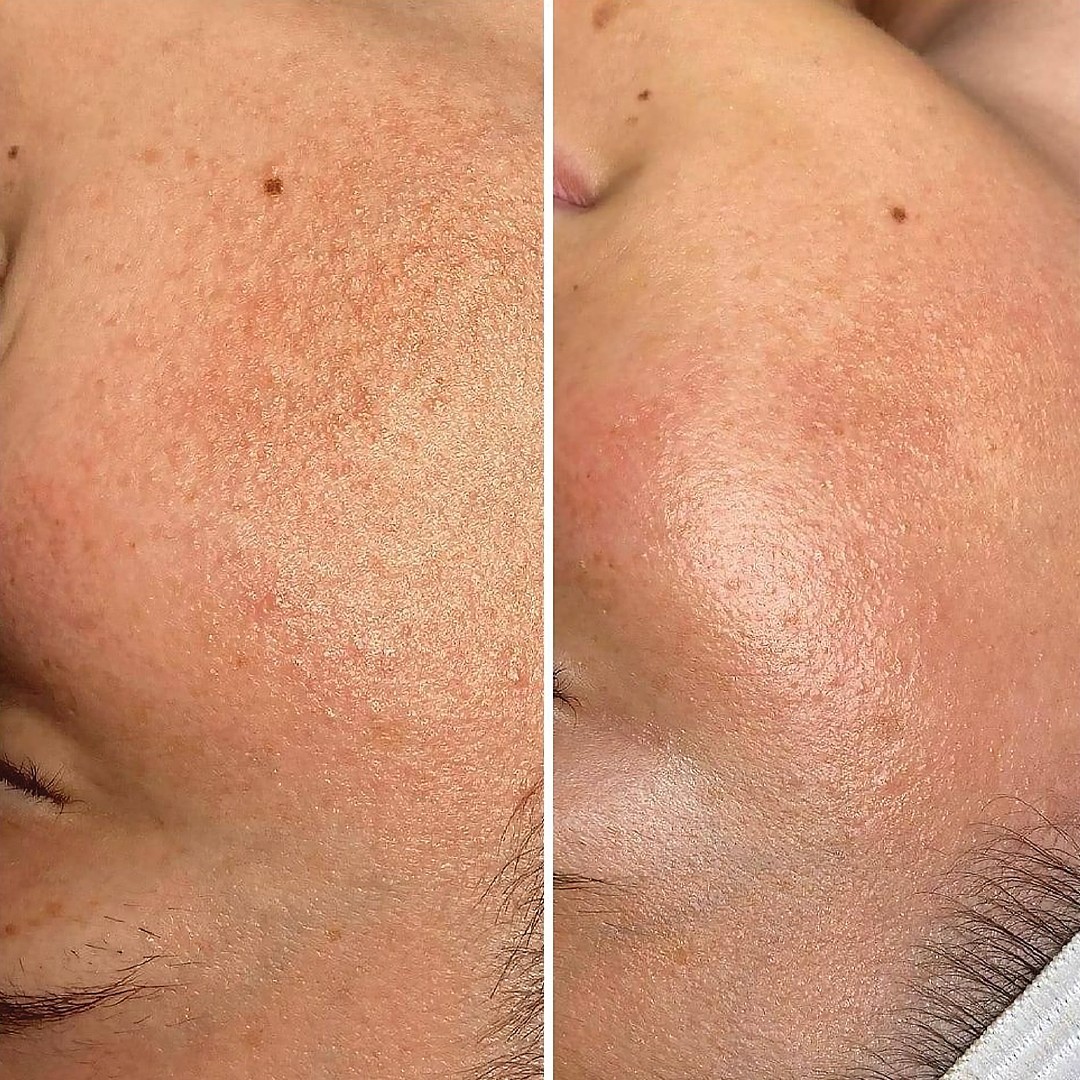 Exofacial texture result